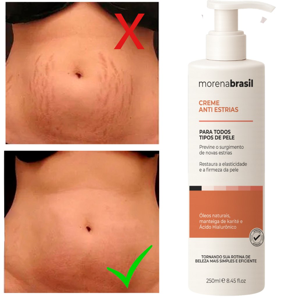 Creme Anti-Estrias - Diga Adeus às Estrias! Previne Novas Estrias & Reforça a Elasticidade D...